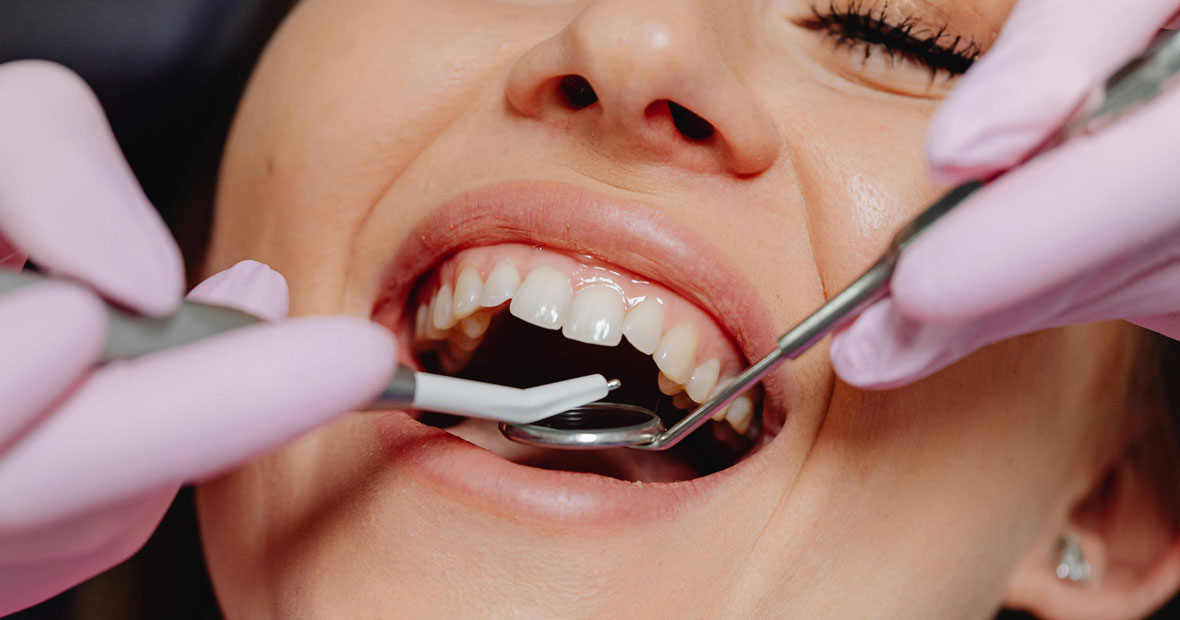 Alimentation et récession gingivale